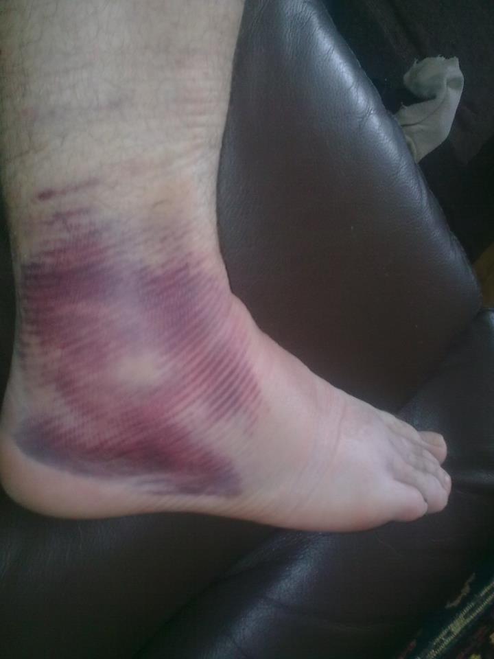 Bruising from torn ligament